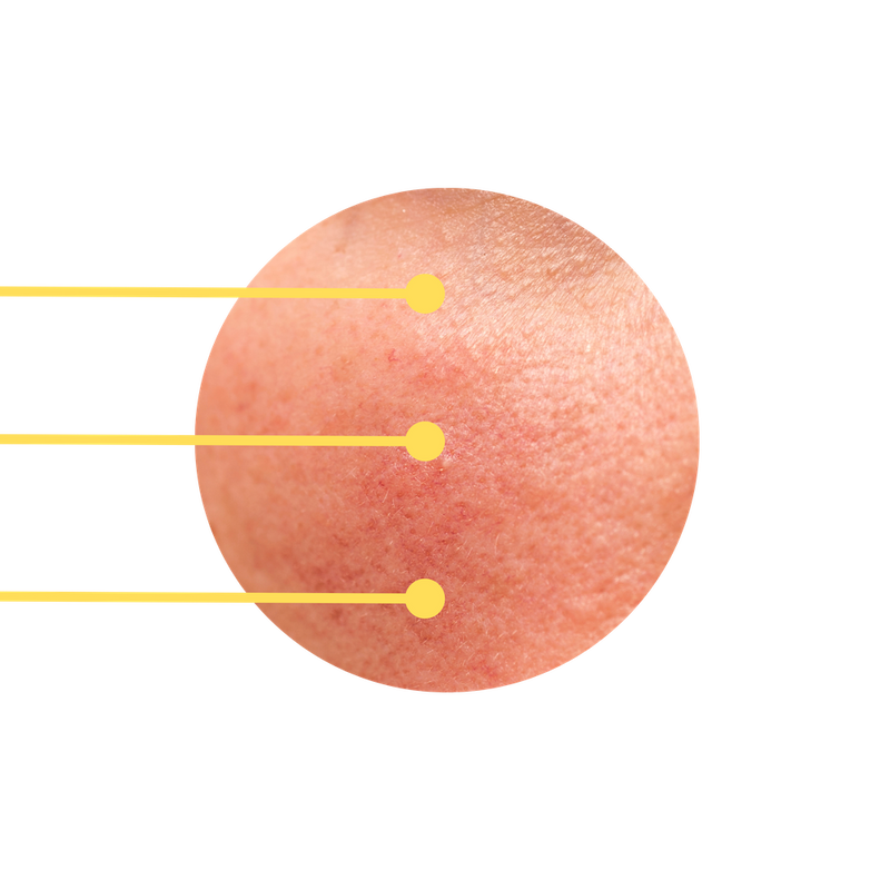 Yellow LED Light beams on skin with rosacea