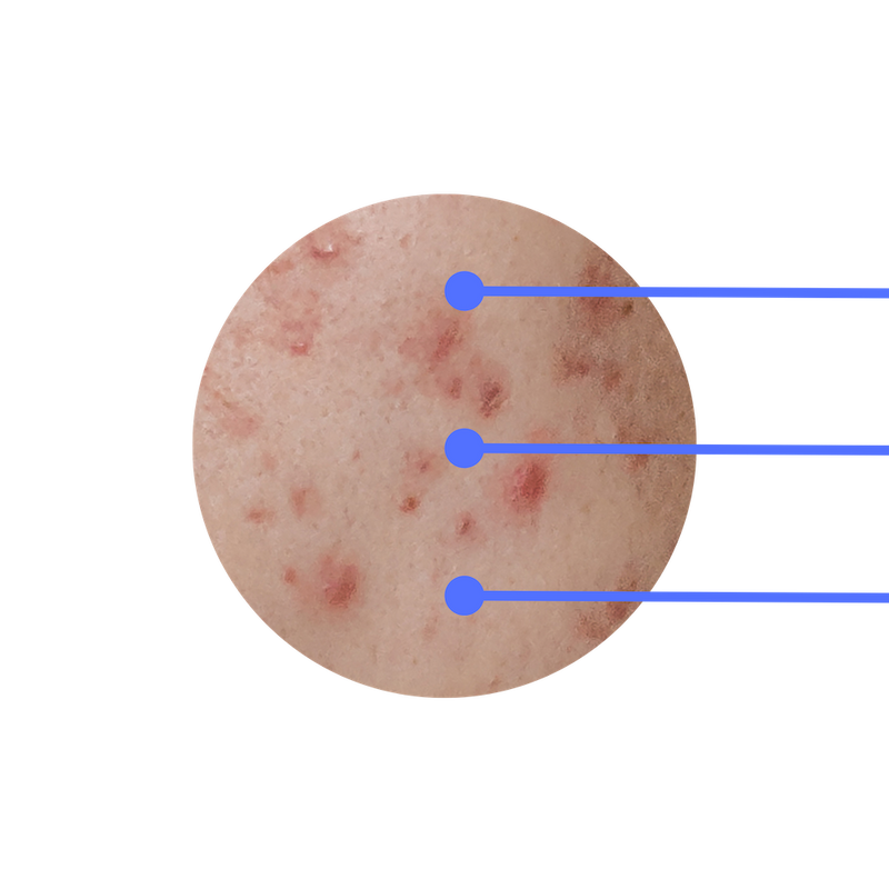 Blue LED light on skin with acne spots