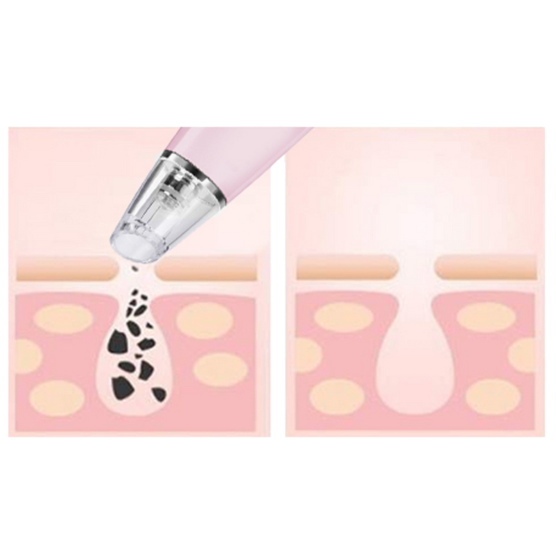 PorePatrol Skin Renewing Pore Extraction System (Pink) | MAGNITONE London | Removes blackheads and dirt